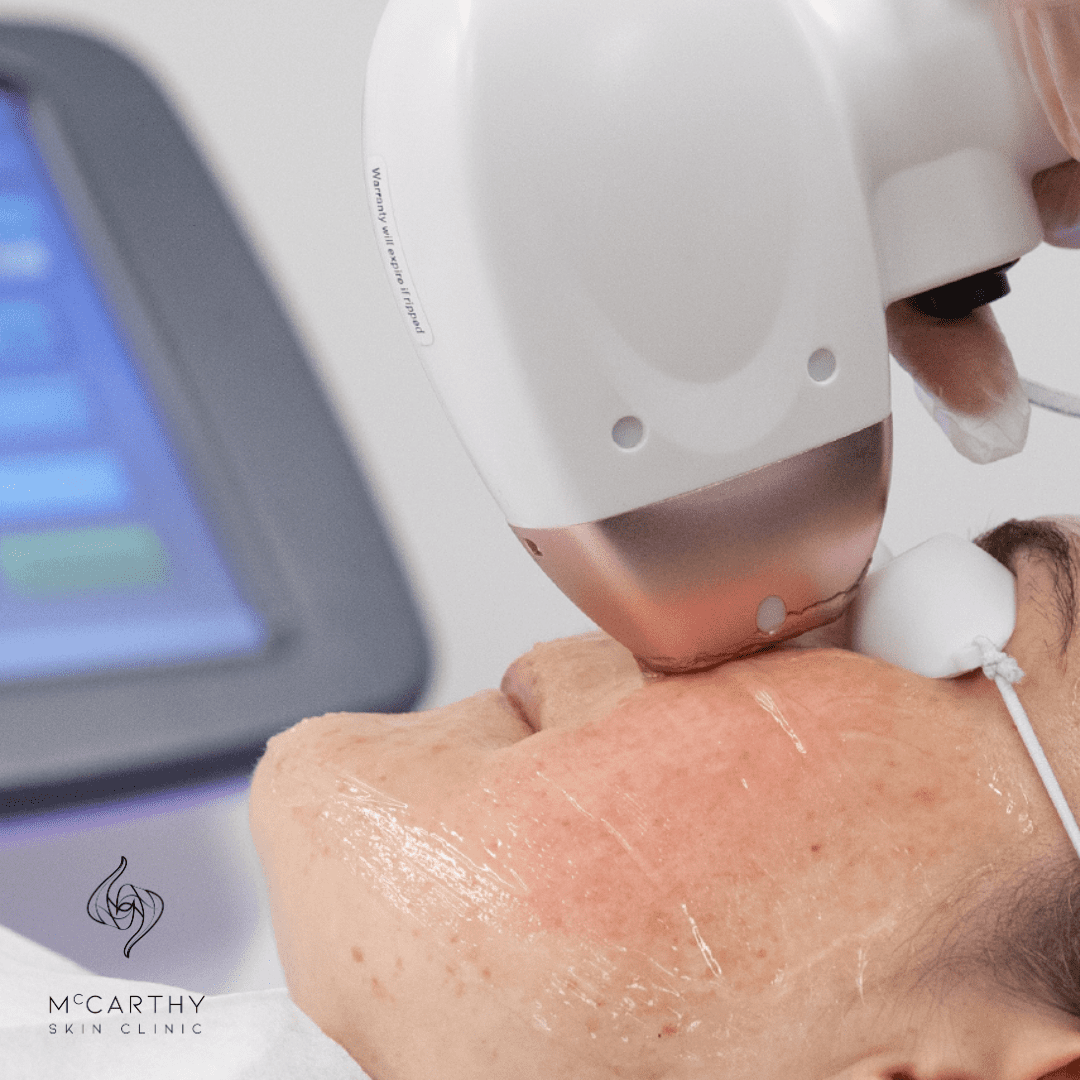Women getting laser hair removal on her face.