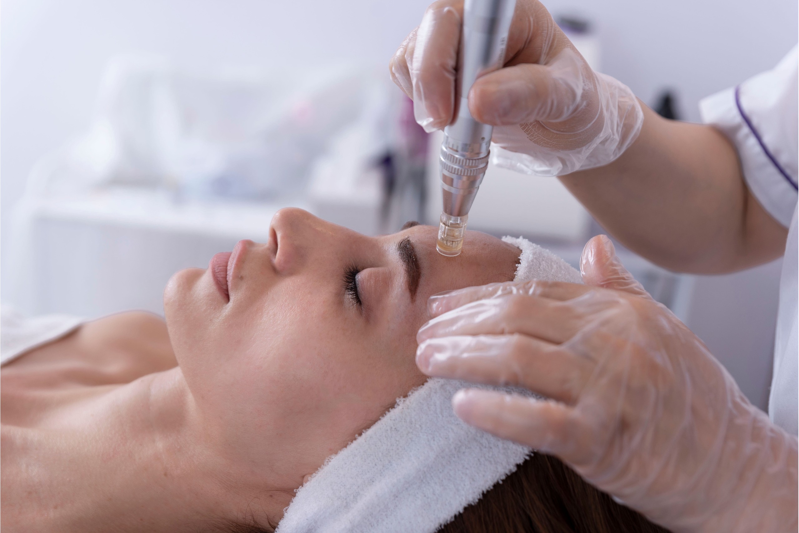 microneedling in milton keynes