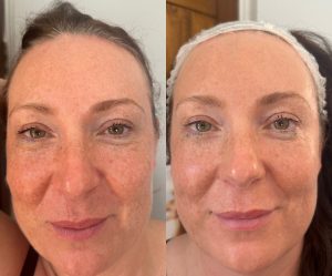 Laser skin rejuvenation in milton keynes