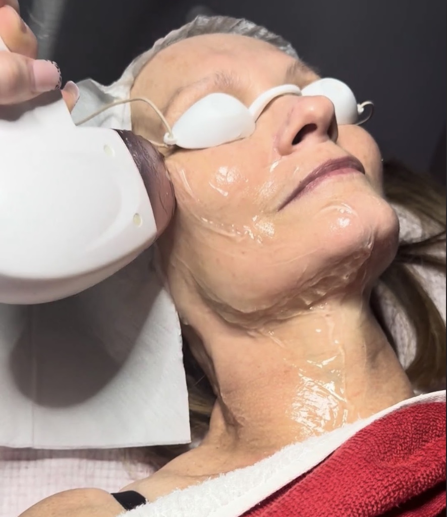 Laser Skin Rejuvenation in Milton Keynes