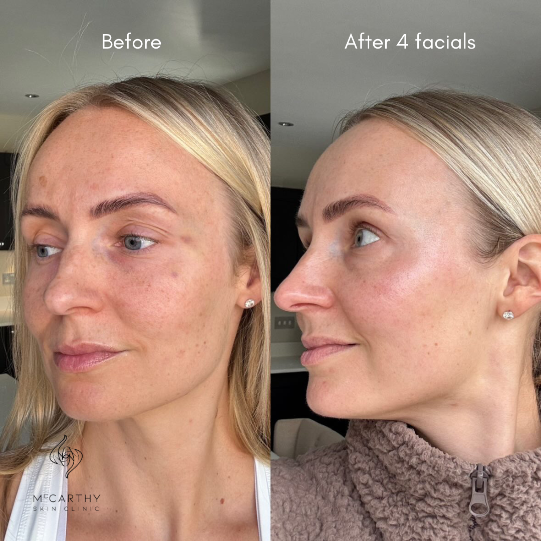 Before and after a course of 4 Visible Age Reverse facials