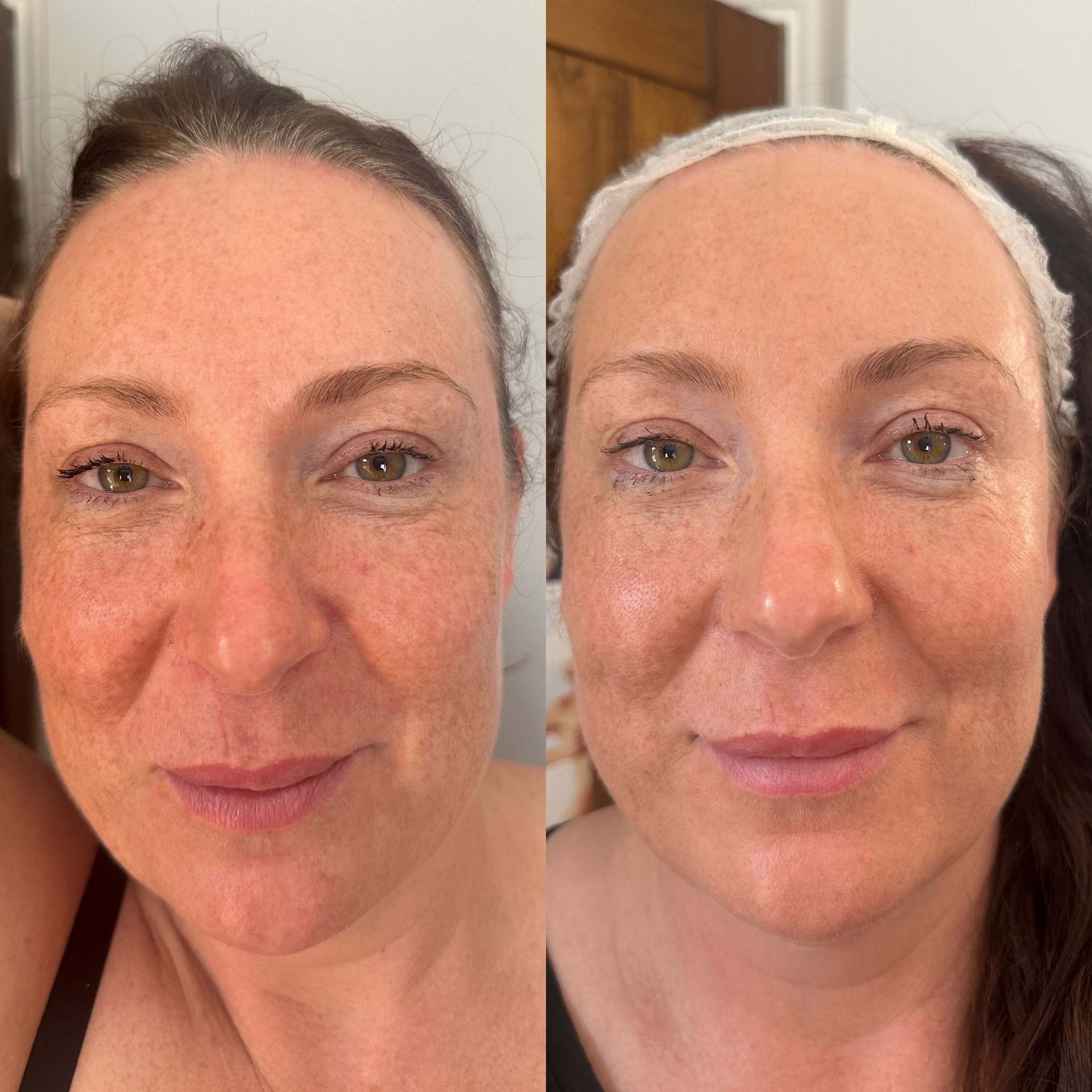 Before & After 1 Treatment of Laser Skin Rejuvenation
