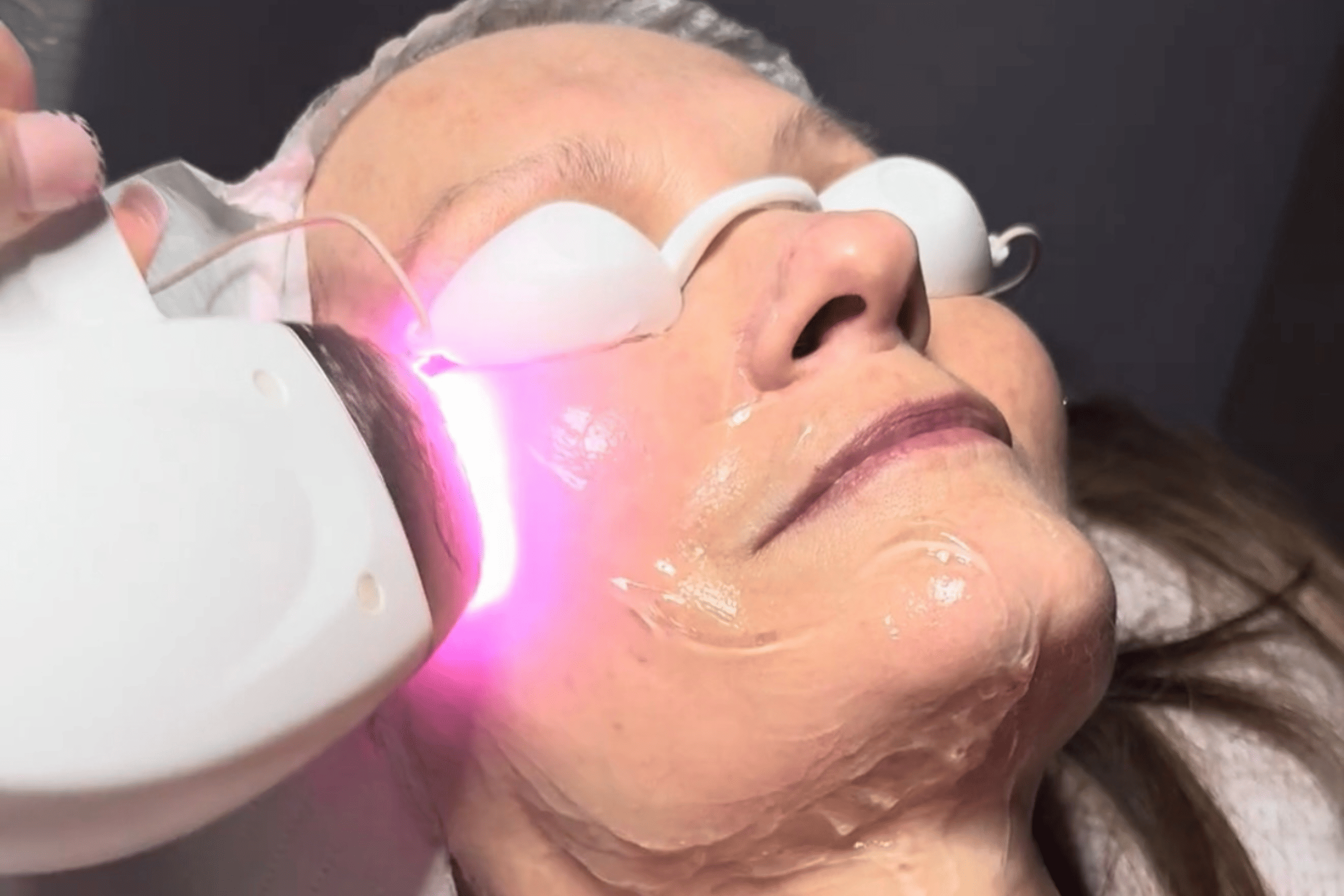 Laser skin rejuvenation