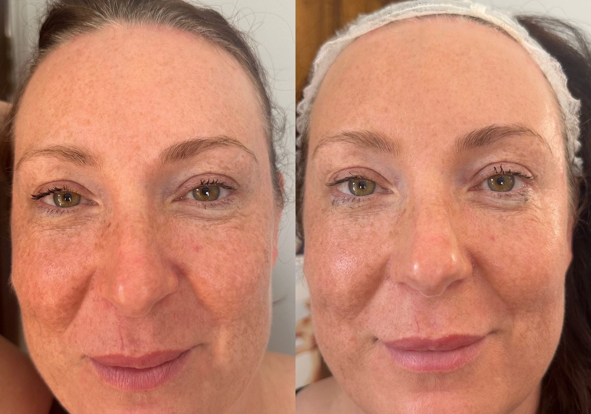 Before & After 1 Treatment Laser skin rejuvenation in milton keynes